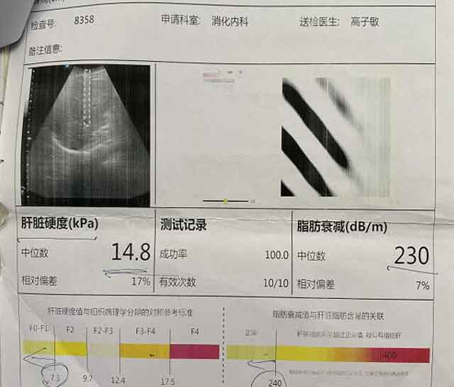 郑州肝硬化医院哪家好?河南治疗肝硬化那个医院好